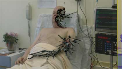metalosis